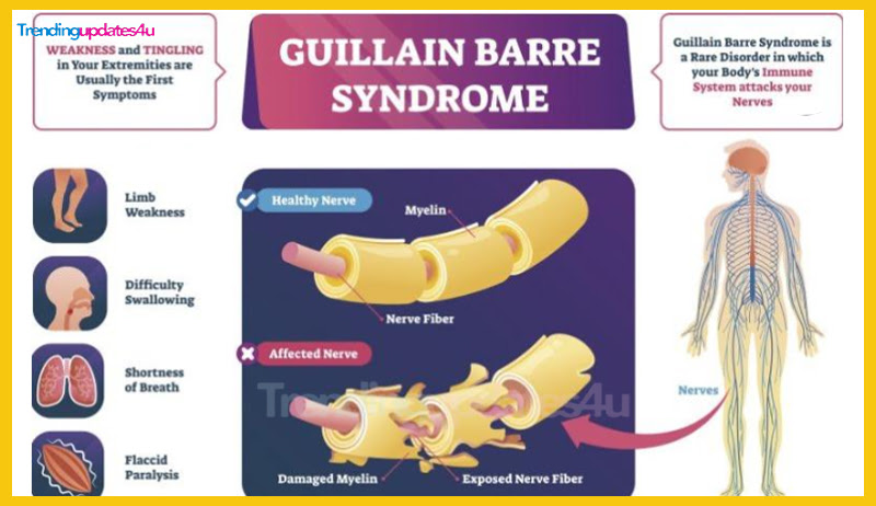 Guillain-Barré Syndrome
