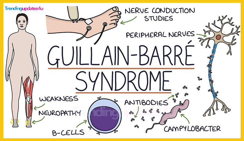 What is Guillain-Barré Syndrome (GBS)